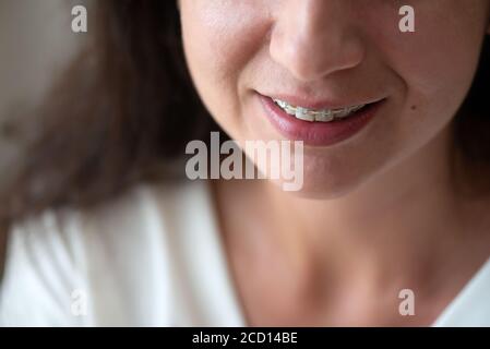 Primo piano donna sorriso con parentesi graffe. Trattamento ortodontico. Corpo positivo. Messa a fuoco morbida Foto Stock