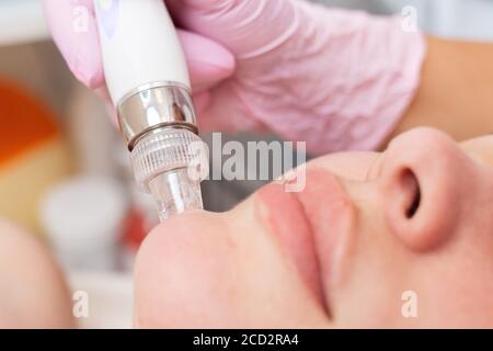 Un cosmetologo in guanti di gomma esegue una procedura di idrospellatura sul viso del cliente. Primo piano del mento e dell'apparecchio. Concetto di cosmetologia e t Foto Stock