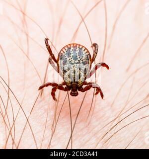 Encefalite infettiva Tick Insect strisciando sulla pelle. Virus encefalite o malattia di Lyme borreliosi infezione Dermacentor Tick Arachnid parassita Macro Foto Stock