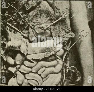 . Terapia medica e chirurgica . Fig. H.-cavità addominale come in Fig. F, dopo aver sollevato l'omen-tum e il colon trasversale. Fig. I. - linea di accesso tra l'omentum e il colon, sezione e distacco dell'omentum e del colon trasversale. FERITE PENETRANTI 513 dello stomaco (Fig. 63), ma per esaminare correttamente la plena dobbiamo prolungare l'incisione indietro in una direzione orizzontale e anche in verticale towardsulla cresta iliaca. L'esistenza di una ferita toracica-addominale può portare a due diversi metodi di azione che Delore.e Kocher [^J hanno molto chiaramente confrontato. Iheydistingu Foto Stock