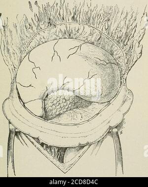 . Terapia medica e chirurgica . Fig. G. - linea di accesso tra il colon trasversale e lo stomaco, attraverso l'omentum, alla superficie posteriore dello stomaco. Il Teomentum è diviso sotto il cerchio arterioso perigastrico ; forcendo è posto sulle arterie omentali.248] FERITE PENETRANTI 511 sary ; la cavità posteriore è ora completamente aperta ; lo stomaco è ora ribaltato dal basso verso l'alto per scoprire la perforazione e sutura esso. Poi l'apertura nell'omentum è cucita in su. Questo metodo è sconveniente perché bsemcstasis è richiesto. Fig. 62.- come la perforazione gastrica è suturata. Questo ha Foto Stock