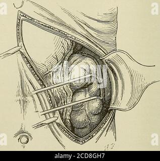 . Terapia medica e chirurgica . -Colon/omentum -^SMA/l intestini Fig. 54.-esposizione dell'angolo destro del colon e degli organi vicini dopo la laparotomia di Kehrs. 5U<) FERITE DELL'ADDOME tional) che danno un'ampia esposizione dell'intera regionas mostrata in Fig. 54. L'angolo splenico viene raggiunto più convenientemente mediante incisione asub-costale con una promolon-gazione verticale esterna (Fig. 55). Quando il colon ha una mesenteria lunga sopra la relativa totalità o in quelle parti che sono generalmente bene. Fig. 55.-laparotomia subcostale sinistra con prolungamento verticale.lo stomaco, la parte superiore della milza Foto Stock