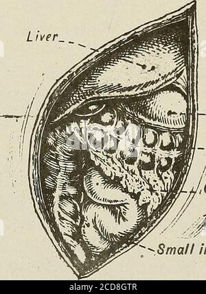 . Terapia medica e chirurgica . ^ esposto durante un'operazione che coinvolge il fegato, come Auvraysincisione prolungata verticalmente verso il basso fino alla sua estremità esterna, un'incisione sub-costale anche proloijged ver-ticamente verso l'esterno, e Kehrs incisione estesa (excep. -Colon/omentum -^SMA/l intestini Fig. 54.-esposizione dell'angolo destro del colon e degli organi vicini dopo la laparotomia di Kehrs. 5U<) FERITE DELL'ADDOME tional) che danno un'ampia esposizione dell'intera regionas mostrata in Fig. 54. L'angolo splenico è raggiunto più convenientemente dall'incisione asub-costale con una verticale esterna Foto Stock