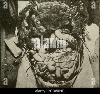 . Terapia medica e chirurgica . Fig. A. – Abdomen ampiamente aperto, gli organi in situ. Tra lo stomaco e il colon trasversale, l'omentum e il mesocolon strettamente Uniti, formano un velo sottile attraverso il quale si intravedono diverse anse dell'intestino situate in alto. Fig. B.-stesso soggetto: Il colon è stato sollevato; si vede la cvirveddeprossione del suo letto attraverso anse dell'intestino tenue; sopra sono tre anse sporgenti dell'intestino tenue. Soggetto wasptosic, con tutte le mesenterie allungate e peduncolate. DIAGNOSI E INDICAZIONI 463 e) la regione lombare dà accesso al kid-ne Foto Stock