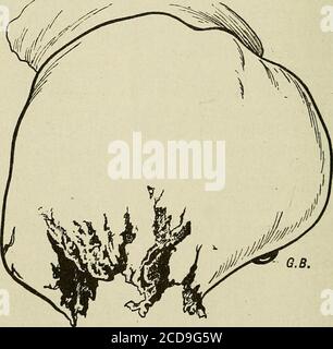 . Terapia medica e chirurgica. Curvatura maggiore abbastanza grande per il pugno di entrare; il grande omentum è stato staccato per 15 cm. In tali casi la lesione è di per sé difficile da trattare, e lo si rende ancora più se accompagnata da una fuoriuscita di liquido settico nel peritoneo. Il colon trasversale è aperto agli stessi commentidell'intestino tenue. E, stimando il pxoba-biHty di heahng spontaneo, non si poteva contonare il fortunato incidente di una libera comunicazione spontanea con l'esterno. :M FERITE DELL'ADDOME nel colon ascendente e discendente, il Foto Stock