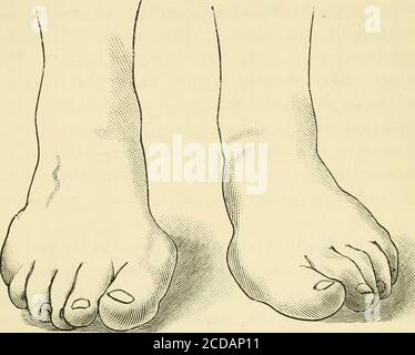 . L'ospedale di San Tommaso riferisce . perato sopra, wasmuch distorto, e formò un contrasto molto marcato -a sinistra, che era in linea retta con il primo osso meta-tarsico. La forma dei suoi stivali mostrava anche la differenza tra i due piedi. L'articolazione precedentemente operata è stata anchilosata in prima persona. Non c'erano bonygrowths, né c'era un bunion sul lato interno. Heaccosented di entrare in ospedale per il funzionamento sul piede destro, ma non ha fatto il suo aspetto, e non è stato visto da allora. Caso 2. – Agosto 1890. – Mabel C-, set. 16, era stato sofferedda dolorose articolazioni di punta grandi per sette anni dopo Foto Stock