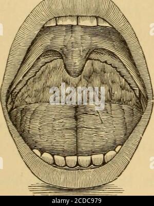 . Malattie della gola e dei passaggi nasali; una guida alla diagnosi e al trattamento delle affezioni della faringe, del sofago, della trachea, della laringe e delle nares. s-deeded azione, l'esalazione normale sarà diventato collectedinto gocce minute che appaiono come gruppi di vescicole, oftenmistaken per vescicole erpetiche, simili a quelle che alcune volte precedono la gola irritata membranosa ordinaria. La membrana mucosa interdistanziata nella vicinitàdi queste macchie di gocce di umidità, pere ap sommerse al contrario, e l'aspetto genero è che un po 'crudo e gran-ulated aspetto così spesso citato. Inquesto Foto Stock