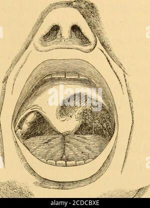. Malattie della gola e dei passaggi nasali; una guida alla diagnosi e al trattamento delle affezioni della faringe, del sofago, della trachea, della laringe e delle narici da soli. I casi avanzati sono riconoscibili, in quanto l'aspectioneirregolare dell'ulcerazione è simile a quello delle devastazioni sifilitiche nel teschino; ma nei casi non molto avanzati o di moderata severità è estremamente difficile, a dir poco, determinare la natura tesifilitica di una laringite dal suo semplice aspetto. Una croniclaringite in una costituzione senza dubbio esente da tuberculomalattia dei polmoni, e soprattutto in assenza di evidenza di strum Foto Stock