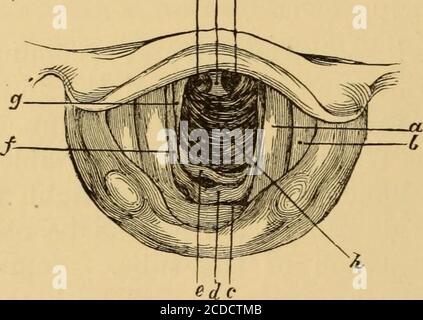 . Malattie della gola e dei passaggi nasali; una guida alla diagnosi e al trattamento delle affezioni della faringe, del sofago, della trachea, della laringe e delle narici . sono visti dischi scuri circolari che segnano l'inizio dei bronchi. In casi ineccezionali, se il bronco destro è molto dritto, è possibile che venga proiettata una luce sufficiente per dimostrare diversi itsrings (Fig. 41). Una buona regola per cercare l'immagine della biforcazione è quella di avere una vista distinta della faccia laringea dell'epiglottide, e poi, con questa come guida, di continuare l'ispezionelungo questo piano, a destra in avanti Foto Stock