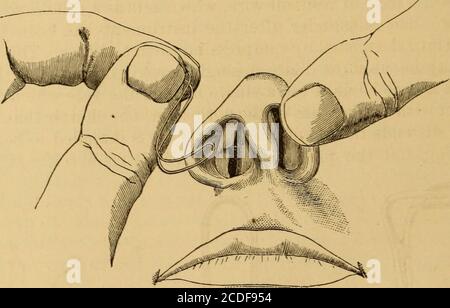 . Malattie della gola e dei passaggi nasali; una guida alla diagnosi e al trattamento delle affezioni della faringe, del sofago, della trachea, della laringe e delle nares. Aliva -nt. Variano notevolmente entro i limiti normali. Ispezione diretta dei passaggi nasali ; RHI-noscopia anteriore - Un esame approfondito del pa-sa^s nasale an-teriorly è indicato in tutte le diseas-s che implichano la cavità del thenose sarà spesso sufficiente gettare il paziente testa indietro soas t   il | ssaggi quanto più possibile, in un orizzontale, e lasciare che una buona, forte luce li colga. La luce diurna o la luce artificiale riflessa è ofte Foto Stock