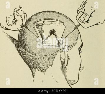 . Terapia medica e chirurgica . Fig. 38.-frattura della base di un lembo osseo mediante trazione con un Farabeufsretractor. Questa procedura approssimativa è molto male sopportata da un paziente che è cosciente. Spot. Oppure può accadere che il durma mater sepa-rator si impiglii in una lacerazione della dura mater.This è molto eccezionale, ma l'ostacolo può essere gener-ally superato passando lo strumento nella direzione di tereverse. Quando la sezione dell'osso è stata compiuta, rimane solo per fratturare la base dell'osso-lembo, che dovrebbe essere percettibilmente più stretta delle sue 810 FERITE superiori DEL bordo DEL CRANIO Foto Stock