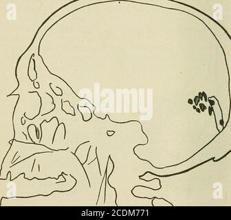 . Terapia medica e chirurgica . EJ*.) Fig. 38.-difetto complesso del campo visivo consecutivo alla penetrazione intra-cerebralica degli schegge [cfr. Seguente radiografia). Hemiopia quadrante inferiore destro con tre congruenti scotomatain emiopico nella metà sinistra di ogni campo visivo. L'operazione con l'obiettivo di estrarre gli schegge sarebbe estremamente grave, e potrebbe solo aumentare il difetto visivo. Radiografia, ma sono, a nostro parere, il mostimportant, perché portano l'infezione. I frammenti di ossa provengono da tutto lo spessore del theskull quando le ferite sono penetranti; se sono 7 Foto Stock