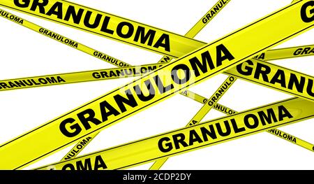 Granuloma. Nastri di avvertimento gialli con parole nere GRANULOMA (è una struttura formata durante l'infiammazione). Isolato. Illustrazione 3D Foto Stock