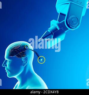 Link, neuralink, nuova tecnologia di intelligenza artificiale che consente di connettersi al cervello umano. Sensori Neuralink pronti per l'installazione Foto Stock