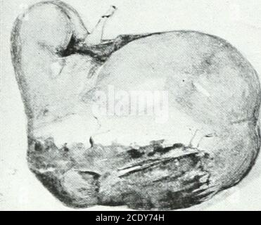 . Annali di chirurgia . GAGE E ADAMS. Altliough nientiuii è fatto nella letteratura della nefrectomia con rimozione del tessuto retroperitoneale della ghiandola come possibile mezzo per assicurare una cura finale, è nostro parere che una tale procedura può solo portare ad una più alta operatix nmrtality tlian ora esiste. Nella nostra esperienza, quei casi che presentano buoni rischi soffrono di grave shock, anche maggiore, quando abbiamo fatto il nothingstym che una nefrectomia rapida e nearlyblood. I bambini VeryYoung non sopportano le procedure majorprocedurali troppo bene. Fur-tlierni(.)re. Noi Ijelieve che i casi avanzati, Foto Stock