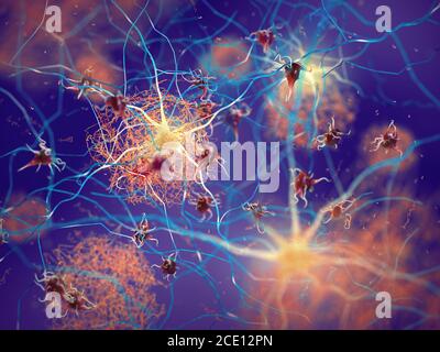 Placche amiloidi che si formano tra neuroni. Proteina beta-amiloide che disturba la funzione delle cellule nervose in un cervello con malattia di Alzheimer Foto Stock