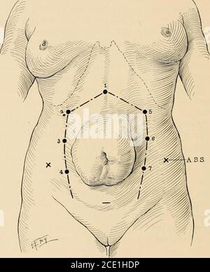 . Anestesia regionale : la sua applicazione tecnica e clinica durante le manovre chirurgiche.la sua associazione con analgesia slancnica (pagina 358) amplia le possibilità chirurgiche della procedura. La liberazione di un'appendice aderente o retrocecale può così essere compiuta senza dolore. Per l'appendectomia nella fase acuta della malattia l'intraspinalblock (anestesia spinale) è la procedura di scelta, a causa del silenzio addominale teresolante che stabilisce condizioni operative e postoperatorie favorevoli. Gli ascessi vengono drenati infiltrando locallylungo la linea di incisione. HERN OMBELICALE Foto Stock