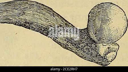 . Traité de chirurgie clinique et opératoire . Fig*. 158. - Déformations rachitiques du fémur (Bosco Muséum). Foto Stock