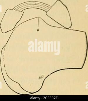 . Traité de chirurgie clinique et opératoire . Tipo 4 h. Tipo 5 b. Foto Stock