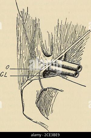 . Chirurgia operatoria, per studenti e professionisti. Varia; possono consistere di intestino, grande o piccolo;di omentum, o di entrambi; e occasionalmente ci possono essere altri organi, come la vescica, l'ovaio, ecc. dopo che il sacco è stato libero-aperto, il suo contenuto dovrebbe essere esaminato. Qualsiasi fascia di costrizione nel corpo del sacco dovrebbe essere diviso, e un tentativo poi fatto topull l'intestino giù in modo da facilitarlo al punto di costrizione; butin questo sforzo molta forza non dovrebbe essere usata. Uno sforzo è fatto alle OPERAZIONI PER L'ERNIA. 441 inserire il dito nel collo del sacco e, se ciò ha esito positivo, Foto Stock