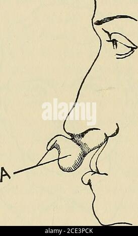 . Chirurgia operatoria, per studenti e professionisti. Ha inviato una scissura del processo alveolare, e questo può variare da una stretta, incompleta fessura ad un ampio, spazio aperto; può essere unilaterale o doppio, ed è di solito associato a 98 TESTA E VISO. Cleft palate. Se non vi è alcuna scossa del palato duro, la scossa del processo alveolare termina al forame palatino anteriore: Il punto di teeting del processo palatale di entrambi i lati e dell'osso intermascellare. Se il cleft nel processo alveolare coinvolge i botsidi, l'osso intermascellare, che è continuo con il frontodel vomero, può b Foto Stock