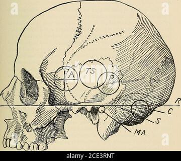 . Chirurgia operatoria, per studenti e praticanti. O la porzione di mastoide proprio, abbastanza vicino al solco che loggia il seno sigmoide, così thatthatthere può essere ma un guscio molto sottile di osso che separa le mastoidcells dal seno. I Mastoidi variano in persone diverse e da parti opposte nella stessa persona come nella misura in cui sono sviluppate le thesecell. Cominciano a svilupparsi presto nella vita, ma il theage differisce a cui sono trovati completamente sviluppati. Da cinque anni sono abbastanza ben marcati, e si dice che all'età offifteen anni sono tutti sviluppati fino alla punta del Foto Stock