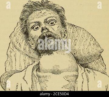 . Elementi essenziali della diagnosi. Disposti sotto forma di domande e risposte preparate appositamente per gli studenti di medicina . inoltre ci sono anche problemi di udito e tinnito aurio, che non sono accompagnamento di epilessia. Gozzo esoftalmico. Quali sono i sjrintomi del gozzo esoftalmico ? Il gozzo esoftalmico, chiamato anche malattia di Gravess e malattia di Basedowsdisease, è un affetto caratterizzato da un aumento della frequenza di infazione e palpitazioni del cuore, la protrusione dei bulbi oculari 352 ESSENZIALI DI DIAGNOSI. E l'allargamento della ghiandola tiroidea. La sua patologia non è stata stabilita. È clinicamente Foto Stock