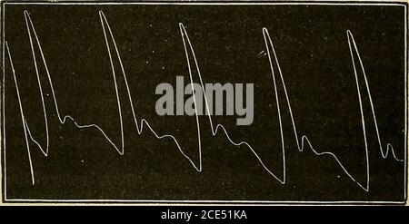 . Elementi essenziali della diagnosi. Organizzato sotto forma di domande e risposte preparate specialmente per gli studenti di medicina . ^ recede: Consente di collegare l'impulso gassoso, l'impulso martello acquoso o il pulseof Corrigan. Questo carattere è ben mostrato nella traccia sphygmo-grafica. (Fig. 21.) Fig. 21.. Traccia del polso dell'insufficienza aortica. (Dopo Striimpell. INCOMPETENCY POLMONARE. 125 Incompetenza Tricuspid - TricuspidRegurgitation. Quali sono i segni di rigurgito tricuspide (incompetenzadella valvola tricuspide) ? Le lesioni delle valvole e degli orifizi del lato del cuore riglit di Tlie sono non comuni. Se il Foto Stock