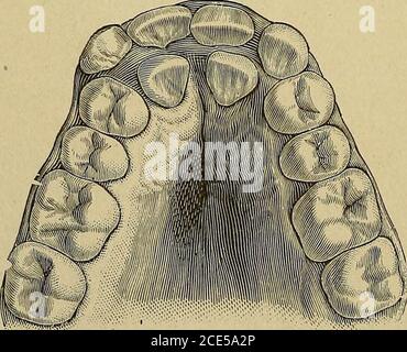 . Ortodontia, o malposizione dei denti umani; la sua prevenzione e il suo rimedio. Successivamente, quando si tenta di correggere la condizione, non sarà sujSicient stanza per accogliere il dente in aspetto più swider e i denti adiacenti dovranno essere presedased o l'arco espanso per ottenere la stanza necessaria;considerando che, se il dente fosse stato girato nella sua sede prima dell'eruzione degli altri denti, l'operazione sarebbe stata molto semplice. Di nuovo, quando un incisore erutta in modo da occupare una posizione all'interno dell'arco nella mandibola superiore, o all'esterno di esso nella fig. 9. abbassamento Foto Stock