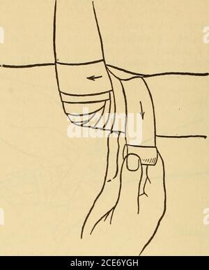 . Dr. Evans' come mantenere bene; . Fig. 34.8.-banda inversa a spirale. Uno. Il reparto sanitario di New York lo modificherebbe omettendo lolio di carron e specificando che la garza e il cotone dovrebbero essere in piccolo olio di Carron è una cattiva medicazione per ustioni. È sporco, è adatto a diffondersi l'infezione; dovrebbe essere omesso. Fig. 349.-gomito di bendaggio. Foto Stock