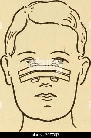 . Dr. Evans' come mantenere bene; . Fig. 327.-trattamento di primo soccorso della frattura di entrambi i ossa della miscela di colera della gamba. Le miscele di colera e paregoriche contengono oppio e devono essere prese con cautela. Arrestare tutti gli alimenti tranne il latte bollito. Se la diarrea persiste consultare un medico. La diarrea nei bambini è una questione più seria e sta prendendo le probabilità. Foto Stock