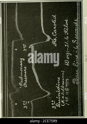 . Il giornale di medicina di laboratorio e clinica . ^^ mmmiilfmii^i &lt;rt^-a.m&lt;Alc^ ..„„».«».„».,.„»».».„?»,  ». Fig. 22. può gettare luce considerevole sulla questione della scelta appropriata di casesfor trattamento di chinidina. La pressione sanguigna polmonare occupa una relazione peculiare con la generalcircolazione in disturbi cardiaci, come fibrillazione o flutter auricolare, e soprattutto quando queste condizioni sono ulteriormente complicate da valvulardisease. Di conseguenza, qualsiasi farmaco che esercita una notevole azione sulla pressione polmonare sarebbe degno di un attento studio quando usato in thetrea Foto Stock