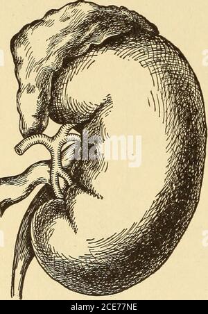 . Dr. Evans' come mantenere bene; . della colonna vertebrale (malattia di Potts), o dei muscoli (ascesso di psoa), o il peritoneo (peritonite) - tutte strutture vicino - si diffonde direttamente ai reni. Il rene di Aroundeach è una capsula tesa, quasi impene-trattabile che lo protegge dalle infezioni dei suoi vicini. L'infezione può viaggiare al rene dal flusso sanguigno e fino agli ureteri dalla vescica. L'organismo infettante più frequentemente è il bacillo del colon, l'OR-ganismo che, fintanto che rimane nell'intestino tenue, è quasi innocuo. Un altro frequentemente trovato è il proteus, un germe Foto Stock