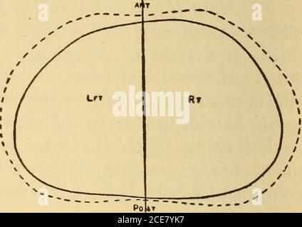 . Dr. Evans' come mantenere bene; . Fig. 86.-rigonfiamento all'indietro sul conteggio AC della Scoliosi. Correzione della scoliosi. Fig. 87.-marcata contrazione di LeftLung, dovuta all'em-fisema postpneumonico. Ripristino del normale pe-rimetro in tre mesi da esercizi. Trattamento tomatico è richiesto, le cose principali da fare sono igieniche. Gli indi-cationi sono, il cambio di latte - per ottenerlo più puro e più ricco; goccia un certo zucchero di starchand dalla dieta; per portare alle condizioni domestiche migliori. Queste sono le cose che devono essere fatte, e questo significa direzione medica. Prima di andare a un medico per una bottiglia di medicina, e poi ad un Foto Stock