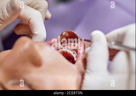 Dall'alto del medico dentistico senza volto che controlla i denti di femmina il cliente indossa le bretelle mentre usa lo specchio per bocca Foto Stock