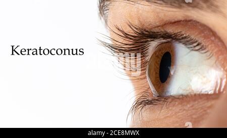 Macro occhio foto. Cheratoconus - malattia oculare, assottigliamento della cornea sotto forma di cono. La plastica cornea. Primo piano, banner. Foto Stock