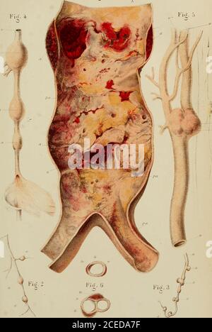 . De la généralisation des anévrysmes miliaires : coesistenza de ces lésions dans le cerveau avec des altérations vasculaires analogies dans différentes parties du corps. Anévrysmes miliaires multiples sur un vaisseau déjà assez volumineux.Figura 3. Dilatations anévrysales de nombre et de formevariés sur un vaisseau cérébral; par placeselles étaient très-riapprovchées.Figura 4. Quatre anévrysmes fusiformes dans un cas dediathèse anévrysmica.(Fait observé par Donald Munro.)v. Vaisseau. a. Anévrysmes vus a lextérieur.ao. Anévrysme ouvertFigura 5. Dilatazioni anévrysales avec altér Foto Stock