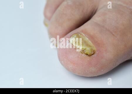 Fungo sulle unghie dei piedi primo piano su sfondo bianco Foto Stock