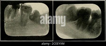 . Anestesia orale; anestesia locale nella cavità orale, tecnica e applicazione pratica nei diversi rami dell'odontoiatria. Fig. 88. Cucitura della ferita. 130 ANESTESIA ORALE su tutti i lati. Tutti i margini e i punti affilati vengono quindi levigati con una bava rotonda e la cavità viene accuratamente lavata con una soluzione antisettica lieve. Ciò è asciugato in su. Bepreewing, stimolare la ferita con un piccolo strumento, per invitebleeding per la formazione di un coagulo di sangue. DRAM il flapdown e cucire con cura con i punti crine. Se si guarisce con la prima intenzione, i punti possono essere rimossi inth Foto Stock