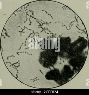 . Microrganismi patogeni, compresi batteri e protozoi; un manuale pratico per studenti, medici e operatori sanitari. 5)ha isolato lo streptococco dal pus di ascessi acuti e ha il nome di Streptococcus pyogenes. Da allora è stato dimostrato di essere uno dei principali fattori eziologici nella produzione di molte infiammazioni suppurative. In passato si pensava che gli streptococchi di eritisipela, acuteascessi, setticemia, febbre puerperale, ecc. fossero simili a specie diverse, perché si osservava che essi possedevano differenze apparentistiche nelle loro caratteristiche biologiche e patologiche Foto Stock