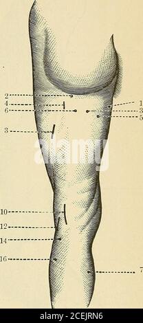 . Un trattato sulle malattie nervose e mentali, per studenti e professionisti della medicina. Punti motore della coscia, superficie anteriore. Superficie posteriore. (Da von Ziemssen.) Fig. 85.-1. Tensor vaginae femoris (ramo del nervo gluteo superiore). 2. Nervo anteriorcrurale. 3. Tensor femorale vaginale (ramo del nervo crurale). 4. Otturatore nervo.5. Eectus femoris. 6. Sartorius. 7. Vastus externi. 8. Adduttore longus. 9. Vastusexterni. 10. Ramo del nervo crurale a quadriceijs extensor cruris. 12. Crureus. 14.Branch di nervo crurale a vastus externi. Fig. 86.-1. Adduttore magnus. 2. gluteo inferiore nerv Foto Stock