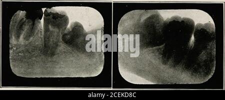 . Anestesia orale; anestesia locale nella cavità orale, tecnica e applicazione pratica nei diversi rami dell'odontoiatria. Fig. 88. Cucitura della ferita. 130 ANESTESIA ORALE su tutti i lati. Tutti i margini e i punti affilati vengono quindi levigati con una bava rotonda e la cavità viene accuratamente lavata con una soluzione antisettica lieve. Ciò è asciugato in su. Bepreewing, stimolare la ferita con un piccolo strumento, per invitebleeding per la formazione di un coagulo di sangue. DraAv il flapdown e cucire con cura indietro con i punti crine. Se guarisce awound dalla prima intenzione, i punti possono essere rimossi int Foto Stock