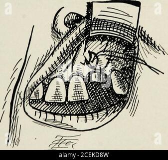 . Anestesia orale; anestesia locale nella cavità orale, tecnica e applicazione pratica nei diversi rami dell'odontoiatria. Fig. 86. La radice del dente è esposta. Fig. 87. Dopo aver amputato la radice e la curetta della cavità.. Fig. 88. Cucitura della ferita. 130 ANESTESIA ORALE su tutti i lati. Tutti i margini e i punti affilati vengono quindi levigati con una bava rotonda e la cavità viene accuratamente lavata con una soluzione antisettica lieve. Ciò è asciugato in su. Bepreewing, stimolare la ferita con un piccolo strumento, per invitebleeding per la formazione di un coagulo di sangue. DraAv il flapdown e cucire indietro Foto Stock