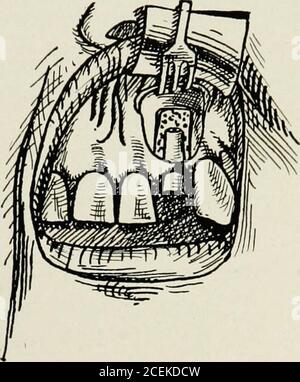 . Anestesia orale; anestesia locale nella cavità orale, tecnica e applicazione pratica nei diversi rami dell'odontoiatria. Fig. 86. La radice del dente è esposta. Fig. 87. Dopo aver amputato la radice e la curetta della cavità. Foto Stock