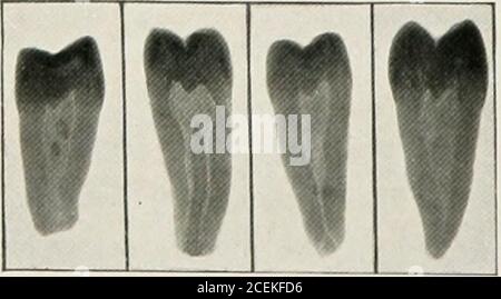 . Anestesia orale; anestesia locale nella cavità orale, tecnica e applicazione pratica nei diversi rami dell'odontoiatria. ve una polpa normale, l'anestesia isRimozione di compiuta allo stesso modo di descritto Polpe normali per preparazioni di cavità (tabelle i e III). A volte da qualche riascui o altro non otteniamo l'anestesia completa della polpa, particolarmente Avhen anaes-thetizing i denti più bassi witli tlie metodo conduttivo. Notando una iniezione speciale per gli incisori, troviamo che la polpa può essere esposta, IMT a causa dell'anastomosi dal lato dell'otlier, è ancora som Foto Stock