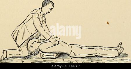 . Medicina della materia dentale, la terapia e la scrittura di prescrizione. Fig. 12.-Sylvesters metodo della respirazione artificiale: Movimento d'ispirazione. Respirazione artificiale, che è qui stessa il migliore stimolatore cardiaco, e senza una fedele continuità, apparirà presto la vera condizione del cuore; poiché la respirazione artificiale non solo fornisce ossigeno, ma facilita l'azione del cuore, alleviando l'ingorgo delle sue camere, ogni dilatazione dei polmoni favorendo lo svuotamento del ventricolo destro e ogni contrazione fornendo più sangue al lato sinistro del cuore per distrar-. Fig. 13.-Sylv Foto Stock