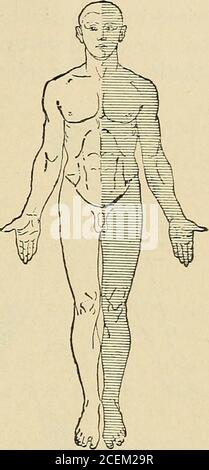 . Malattie del sistema nervoso : per il medico generico e lo studente. Fig. 142 Fig. 143 figg. 142, 143.-emianestesia isterica. (Originale). Le parti anestetiche sono ombreggiate. Sintomi.- le manifestazioni cliniche di isteria sono: Sensoriale, motoria, psichica e viscerale. I. disturbi sensoriali.- influenzano le sensazioni generali come i sensi speciali. L'anestesia è il caso più frequente. È caratterizzata dalla sua mobilità; scompare e riappare; si modifica la sua intensità sotto l'influenza della causa più insignificante. Il theeat di anestesia isterica presenta un grande Foto Stock