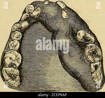 . Lesioni e malattie delle mascelle : il saggio del premio Jacksonian del Royal College of Surgeons of England, 1867. n giugno 3 il paziente è stato dimesso bene. Un esame microscopico del sig. Charles Tomes, ha dimostrato che la struttura della crescita assomigliava strettamente a quella dei piccoli polpi che si trovano a volte occupando la tecavità dei denti cariosi: Era un vero ipertrofia della gomma, e soprattutto della porzione fibrosa. Si è protratto dal periosteo attorno al collo dei denti, appena dentro il temarga degli alveoli. Da questo punto uno stroma denso di fibre interlaccianti, ricoperto da una sottile mucosa A. Foto Stock