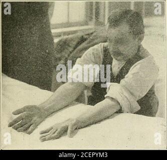 . Contributi del Dipartimento di Neurologia e del laboratorio di Neuropatologia (ristampe). Dulla oblonata non mostra alcuna degenerazione delle anteriorpiramidi. Le cellule dell'oliva inferiore sono normali in numberbut sono molto più piccole. I nervi ottici e il chiasmo non sono degenerati. Sono indebitato per le fotografie che illustrano questo caso a Dr.Allan J. Smith. Il seguente caso clinico di atassia di Friedreichs è stato molto frequente nel mio servizio al Philadelphia General Hospital, ed è stato studiato anche dai miei colleghi del personale neurologico. È incluso a causa della pronunciata atrofia di Foto Stock