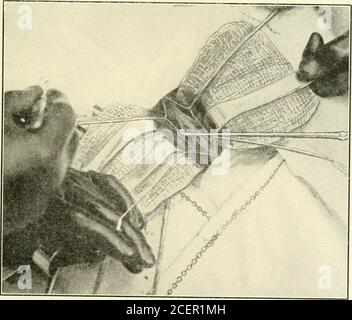 . Contributi del Dipartimento di Neurologia e del laboratorio di Neuropatologia (ristampe). canal durante l'operazione deve essere rimosso per irrigazione e spugnatura, al fine di evitare ogni possibile fonte di trauma,e prima che la ferita durale sia finalmente chiusa ogni vestigedel sangue deve essere rimosso nello stesso modo, come un piccolo coagulo, se lasciato rimanere, può causare pressuresintomi indesiderabili. È inutile dire che una volta che i meningessono stati aperti, bisogna essere scrupolosamente attenti a evitare di traumatizzare il cordone e le sue radici. L'evasione di traumi, emorragie e infezioni Foto Stock